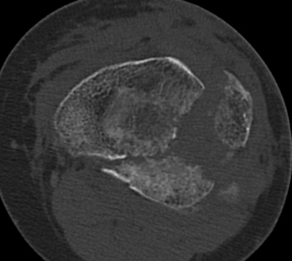 Posterolateral Tibial Plateau